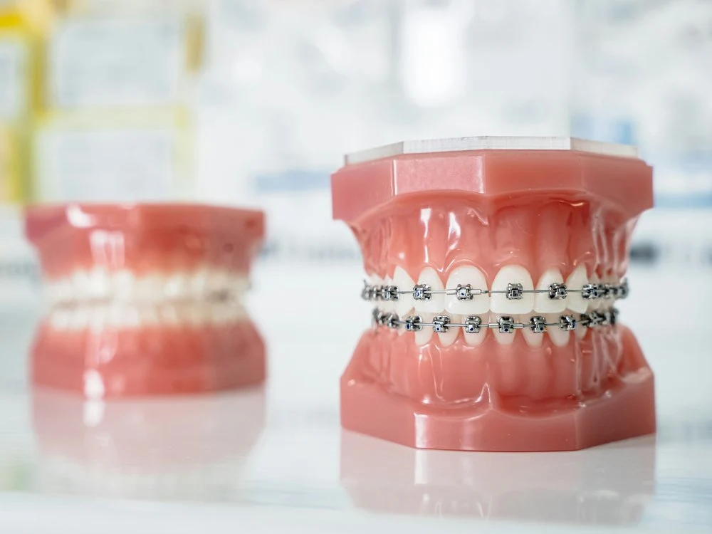 Modelo de brackets de ortodoncia